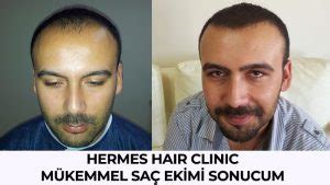 Yazarımız Hermest Saç Ekim Merkezi Yorumlarını ve Sonuçlarını 